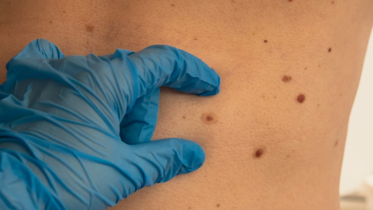 hand in medical gloves looking at skin condition